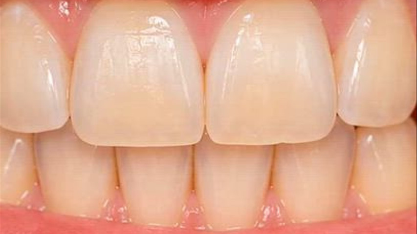 Smilyn - Blanqueamiento Dental