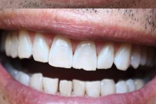 Smilyn - Blanqueamiento Dental - 1