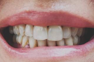 Smilyn - Blanqueamiento Dental - 2