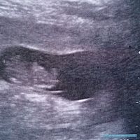 Ayuda con método ramzi: niño o niña? - 1