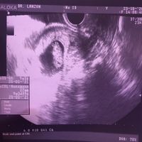 Ayuda con método ramzi: niño o niña? - 1
