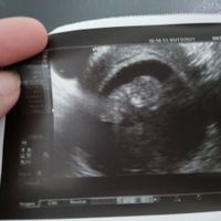 Ayuda con método ramzi: niño o niña? - 1
