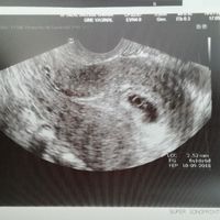 Ayuda con método ramzi: niño o niña? - 1