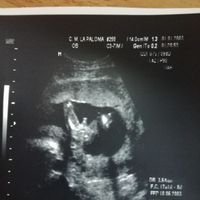 Tubérculo genital niño o niña??? - 1