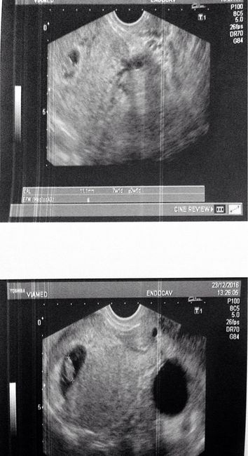 Embarazo y endometriosis 1