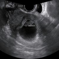 8 semanas y 5 dias