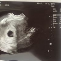 Ayuda con método ramzi: niño o niña? - 1