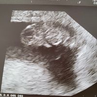Ayuda con método ramzi: niño o niña? - 1