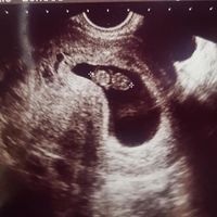 Ayuda con método ramzi: niño o niña? - 1