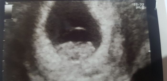 Ayuda con método ramzi: niño o niña? - 1