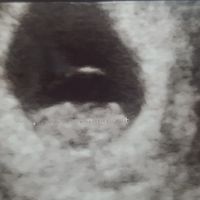 Ayuda con método ramzi: niño o niña? - 1
