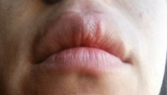 Herpes labial a 4 dias de la boda!!! - 1