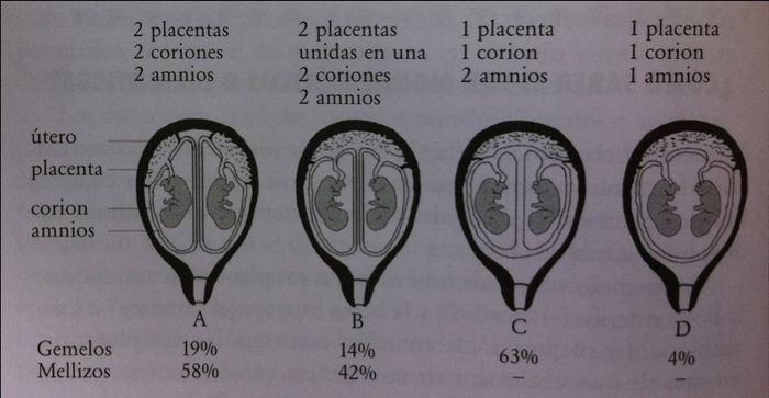 Gemelos monocoriales y posiblemente monoamnioticos - 1