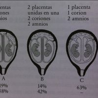 Gemelos monocoriales y posiblemente monoamnioticos - 1