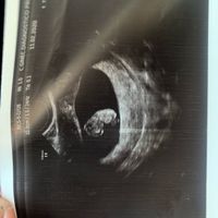 Ayuda con método ramzi: niño o niña? - 1