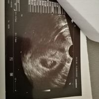Ayuda con método ramzi: niño o niña? - 1