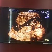 Ayuda con método ramzi: niño o niña? - 1