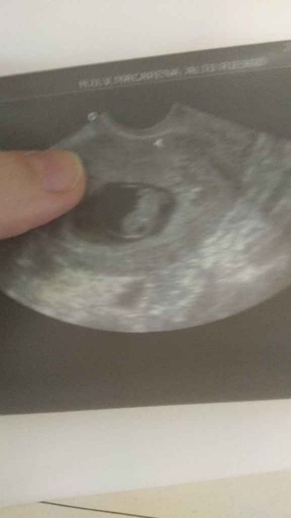 Ayuda con método ramzi: niño o niña? - 1