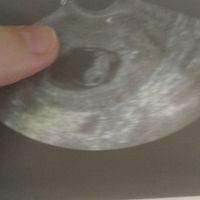Ayuda con método ramzi: niño o niña? - 1