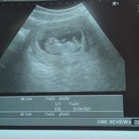 Ayuda con método ramzi: niño o niña? - 1