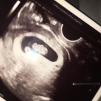 Ayuda con método ramzi: niño o niña? - 1