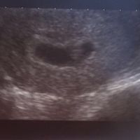 Ayuda con método ramzi: niño o niña? - 1