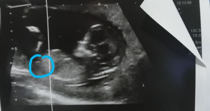 Ayuda con método ramzi: niño o niña? - 1