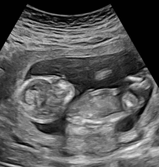Ayuda con método ramzi: niño o niña? - 1