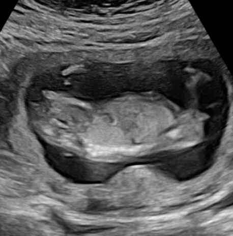 Ayuda con método ramzi: niño o niña? - 2