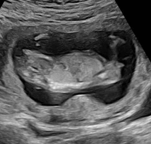 Ayuda con método ramzi: niño o niña? - 3