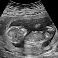 Ayuda con método ramzi: niño o niña? - 1
