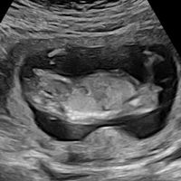 Ayuda con método ramzi: niño o niña? - 2