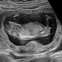 Ayuda con método ramzi: niño o niña? - 3