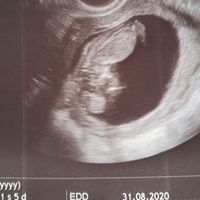 Ayuda con método ramzi: niño o niña? - 2