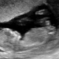 Ayuda con método ramzi: niño o niña? - 1