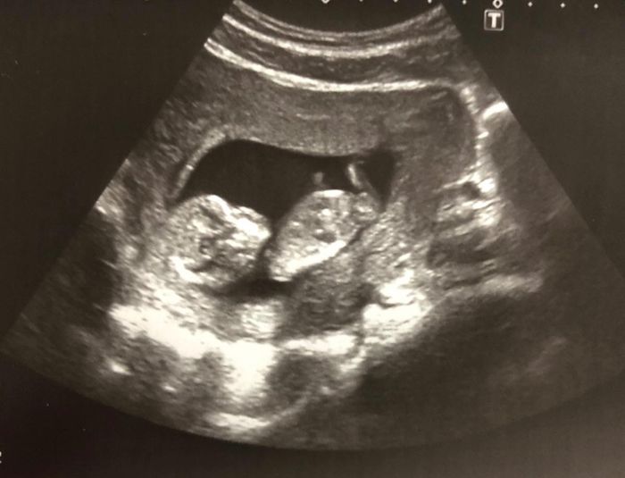 Niño o niña - 2