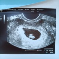 Ayuda con método ramzi: niño o niña? - 1