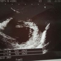 Ayuda con método ramzi: niño o niña? - 1