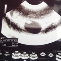 Ayuda con método ramzi: niño o niña? - 1