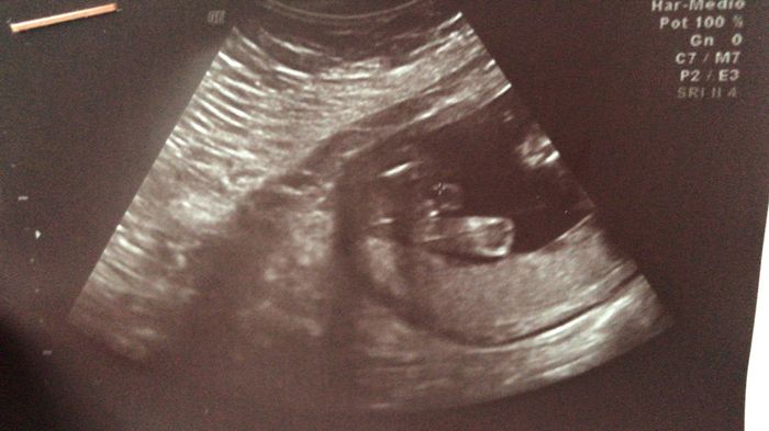 Tubérculo genital: niña 4