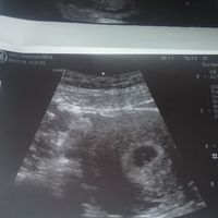 Ayuda con método ramzi: niño o niña? - 1