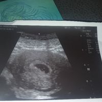 Ayuda con método ramzi: niño o niña? - 2
