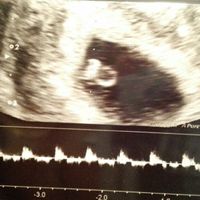 Ayuda con método ramzi: niño o niña? - 1