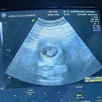 Ayuda con método ramzi: niño o niña? - 1