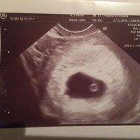 Ayuda con método ramzi: niño o niña? - 1