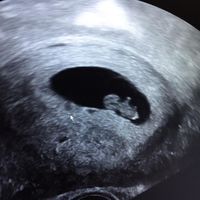 7+5 vaginal