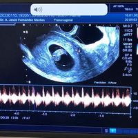 Método Ramzi - 1