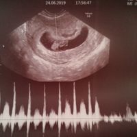 Ayuda con método ramzi: niño o niña? - 1