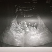 Ayuda con método ramzi: niño o niña? - 1