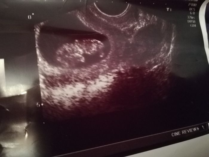 Metodo saad ramzi para saber el sexo del bebe - 1